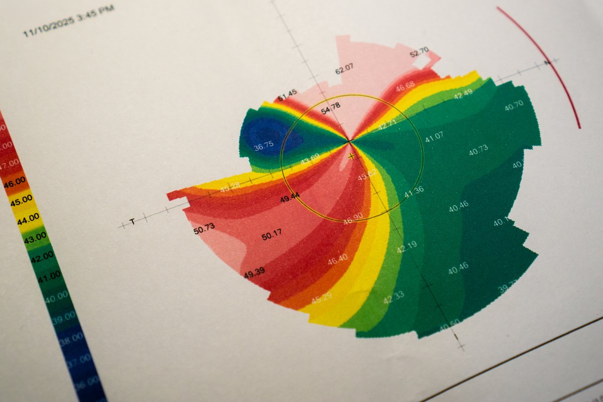 photo of the scan they gave me of my right cornea